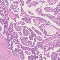 乳頭状腎細胞癌